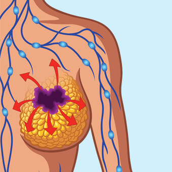 breast cancer s3 causes